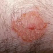 Nipple Rash Nelson