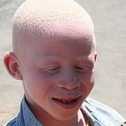 Enano Albino